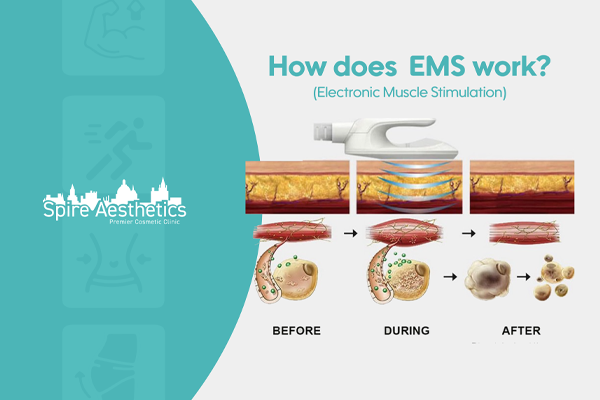EMS treatment for post pregnancy weight loss treatment Maryhill