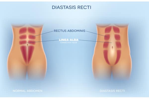 What Non-Surgical Options Are Available for Diastasis Recti Maryhill?