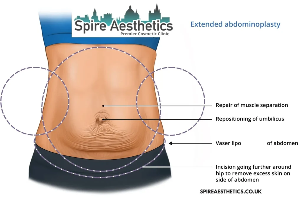 Understanding Loose Skin After Gastric Band Maryhill Surgery and HIFU Treatment