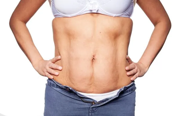 sagging skin on woman's stomach after weight loss injections Maryhill