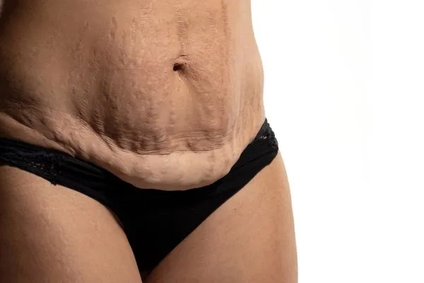 Image of womans stomach after weight loss injections Maryhill showing saggy skin